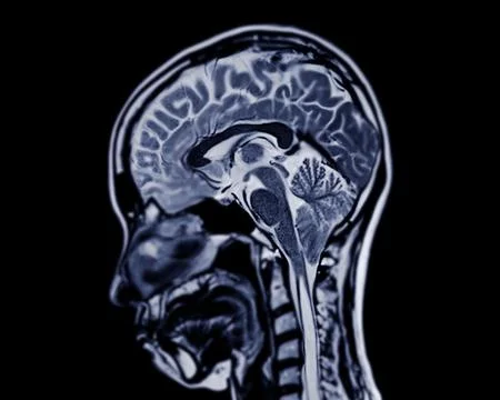 MRI  brain scan  sagittal plane for detect  Brain  diseases sush as stroke .. Stock Illustration