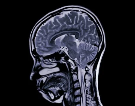 MRI  brain scan  sagittal plane for detect  Brain  diseases sush as stroke .. Stock Illustration