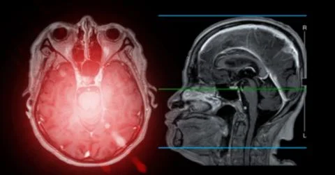 MRI  brain scan  sagittal plane for detect  Brain  diseases sush as stroke .. Stock Illustration
