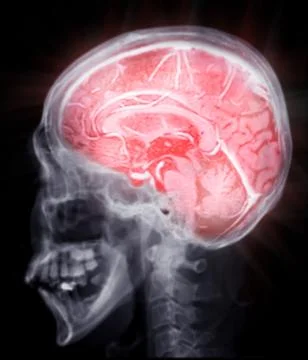 MRI  brain scan  sagittal plane for detect  Brain  diseases sush as stroke .. Stock Illustration
