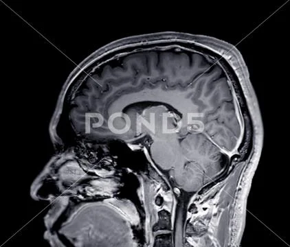 MRI brain scan sagittal T1W plane for detect Brain diseases sush as str ...