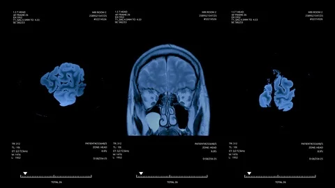 MRI brain scan screen animation. Diagnosis medical data Stock Footage 127026041