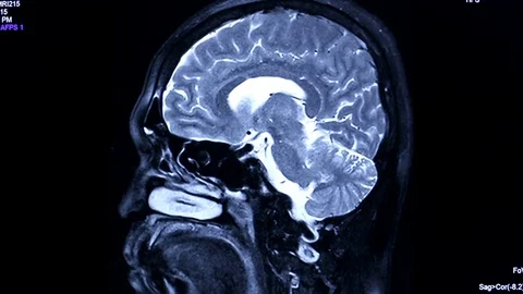 Powerful Mind Brain X-Ray, Stock Video