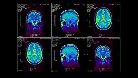 MRI of the brain in three dimensions, video loop, alpha Stock Footage