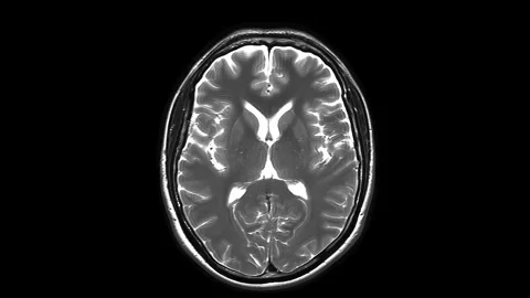 MRI of the Brain in Vertical Projection 4K Stock Footage 329364291
