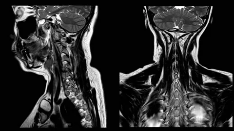MRI C-Spine There is hypersignal intensity lesion in the spinal cord at C4 to Stock Footage 158902174
