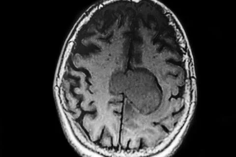 MRI of cerebral lesion located in the middle line parietal -frontal area. Stock Photos