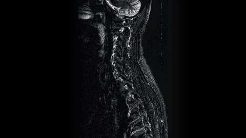 MRI of the cervical spine, detection of protrusions and hernias Stock Footage 118265052
