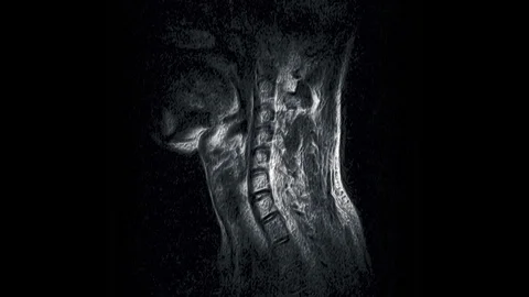 MRI of the cervical spine, detection of protrusions and hernias Stock Footage 118265061