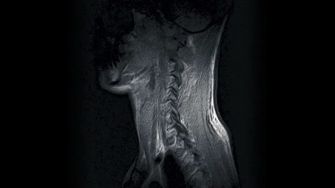 MRI of the cervical spine, detection of protrusions and hernias Stock Footage 118265073