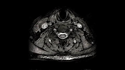 MRI of the cervical spine, detection of protrusions and hernias Stock Footage 118265087