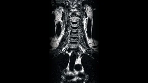 MRI of the cervical spine, detection of protrusions and hernias Stock Footage 118265088