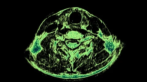 MRI of the cervical spine, detection of protrusions and hernias Stock Footage 118265093