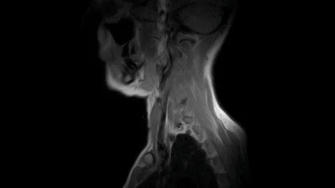 MRI of the cervical spine, detection of protrusions and hernias Stock Footage 126212350