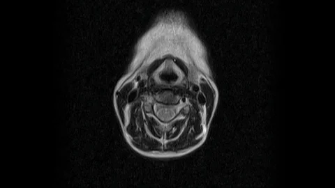 MRI of the cervical spine, detection of protrusions and hernias Video stock 126957961