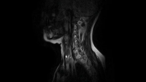 MRI of the cervical spine, detection of protrusions and hernias Video stock 126958079