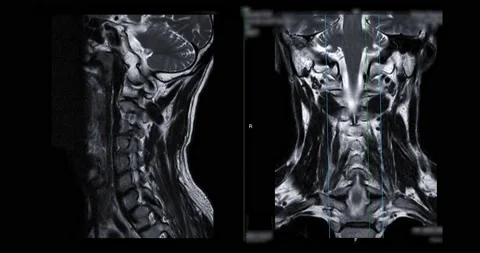 MRI of cervical spine . Stock Video Pond5