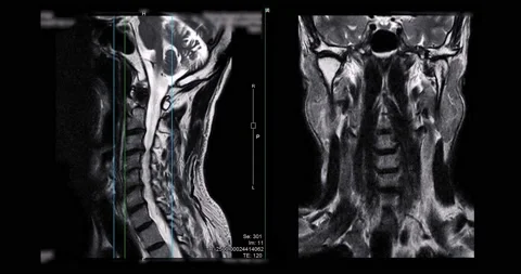 MRI of cervical spine . Stock Footage 195094909