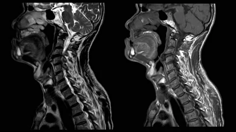MRI OF CERVICAL SPINE IMPRESSION: Moderate to severe posterior central disc p Stock Footage 158902166