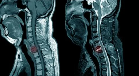MRI of cervical spine Stock Photos