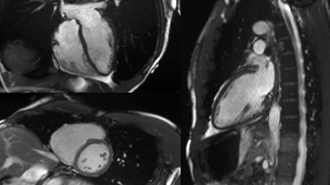 MRI composite image of a beating heart Stock Footage
