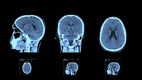 MRI CT Scan of Human Brain | Stock Video | Pond5