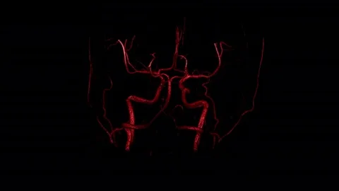 Mri head angio  Stock Footage 82104191