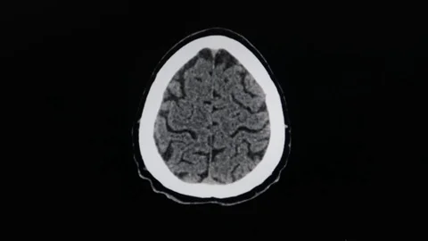 MRI of head / brain, CT scan axial footage Stock-Footage 121707355