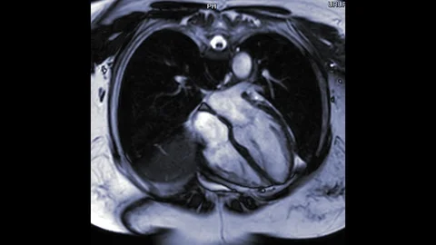 Mri heart Stock Footage 104862875