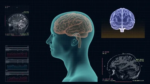 MRI of the human brain in the sagittal projection Stock Footage
