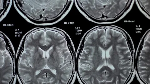 Mri human brain scan concept of hospital health science laboratory medicine Stock Footage 336561163
