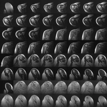 MRI of humerus Stock Photos