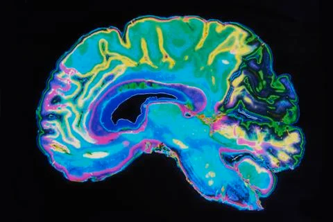 Mri image brain on black background Stock Illustration