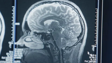 MRI image Видео 321379522