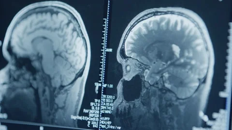 MRI image Видео 321379584