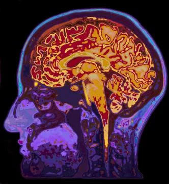 MRI Image Of Head Showing Brain Stock Illustration