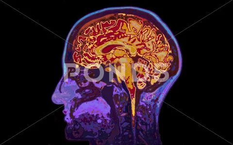 MRI Image Of Head Showing Brain Stock Photos
