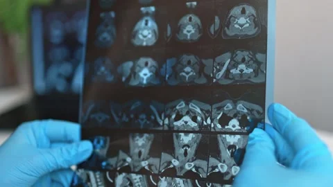 MRI image of the thyroid gland. Stock Footage 289328242