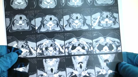 MRI image of the thyroid gland. Stock Footage 289328530