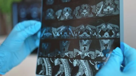 MRI image of the thyroid gland. Stock Footage 289328591