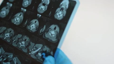 MRI image of the thyroid gland. Stock Footage 289328839