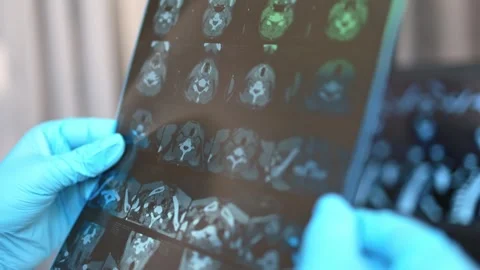 MRI image of the thyroid gland. Stock Footage 289329074