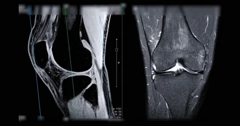 MRI knee . Stock Footage 195094908