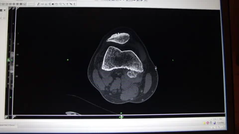 MRI-knee Stock Footage 239366267