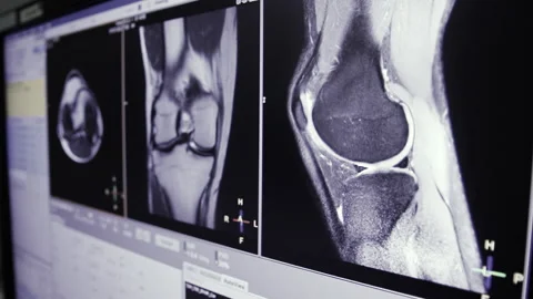 MRI Knee joint or magnetic resonance imaging of the knee for diagnosis trauma 스톡 동영상 202008366