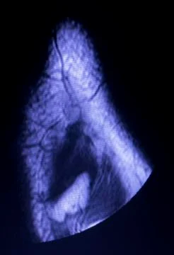 MRI knee meniscus tear scan Stock Photos