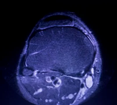 MRI knee meniscus tear scan Stock Photos