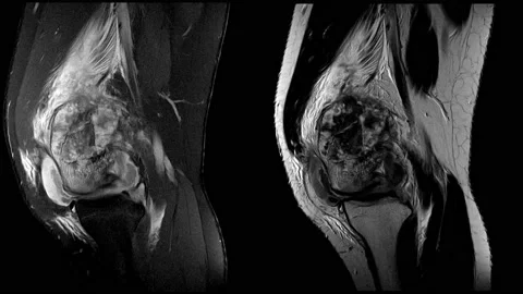 MRI Knee10092564-03 Stock Footage 158902325
