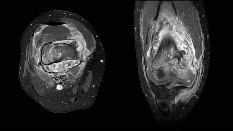 MRI Knee10092564-04 Stock Footage 158902331