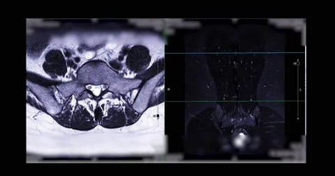 MRI L-S spine . Stock Footage 194252154